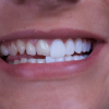 Dental Crowns in Sunshine Coast and Composite Veneers in Melbourne