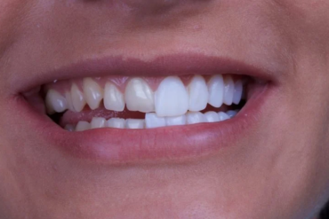 Dental Crowns in Sunshine Coast and Composite Veneers in Melbourne