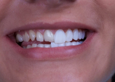 Dental Crowns in Sunshine Coast and Composite Veneers in Melbourne